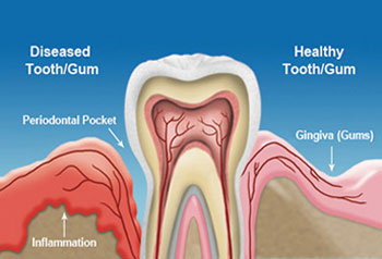 Phoenix Gum Disease Treatment