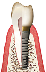 dental implants in Phoenix