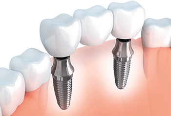 Tooth Replacement in Phoenix